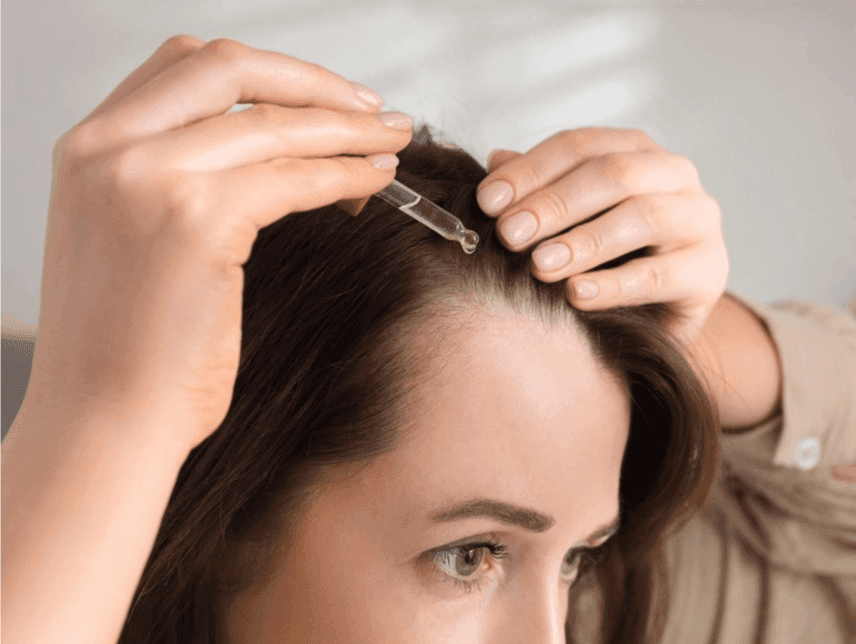 Application of Minoxidil Extra Strength